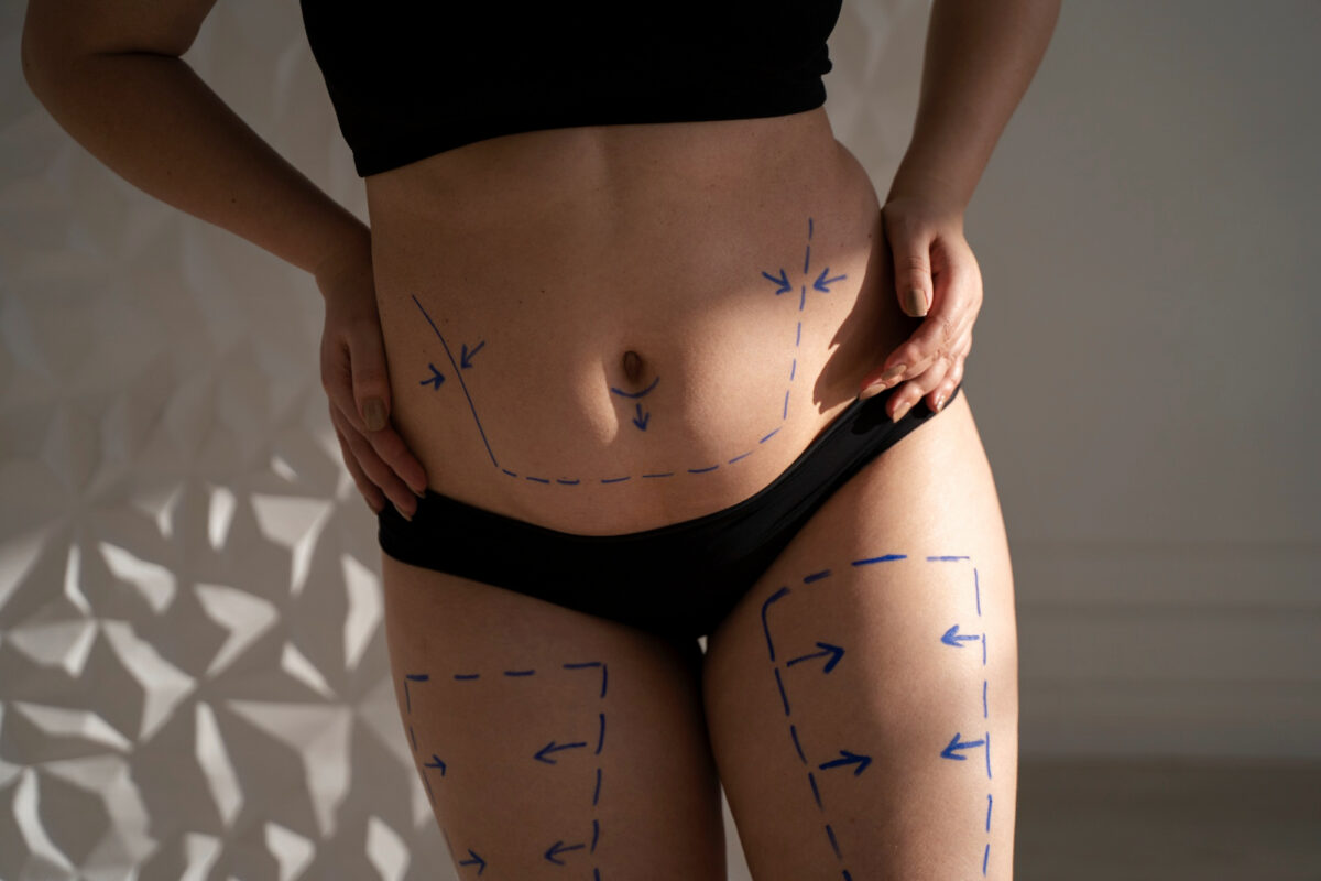 lipo doctors lipodem 2 2152023604-Lipo-Doctors-Lipödem